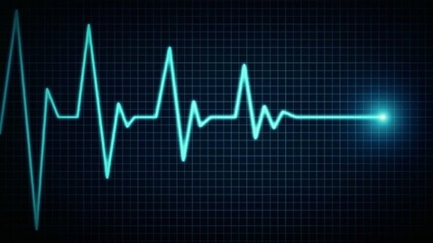 sinus rhythm chart